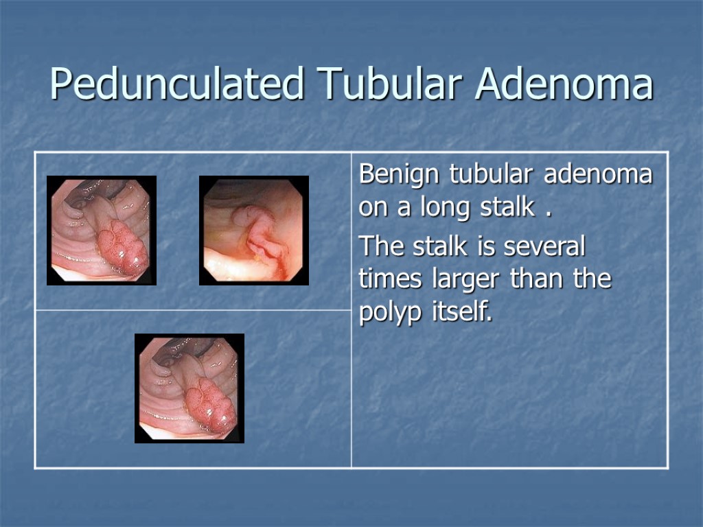 Pedunculated Tubular Adenoma